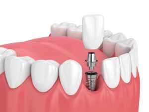 dental implants in plano, tx