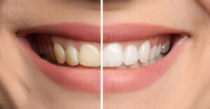 teeth whitening in plano, tx