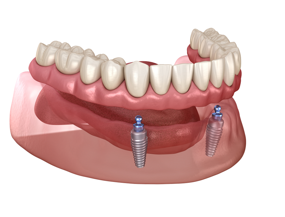 A 3D illustration of All On 4 Dental Implants in Plano, TX.