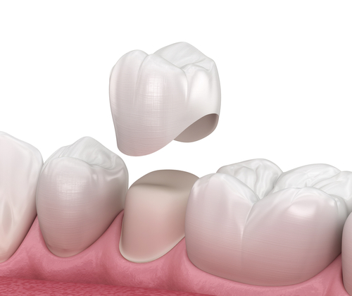3D illustration of dental crowns similar to those placed by Dr. Ragnell