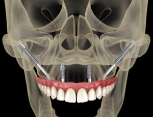 Example of zygomatic dental implants for patients with bone loss