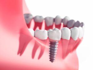 An illustration of single dental implants placed in Plano, TX