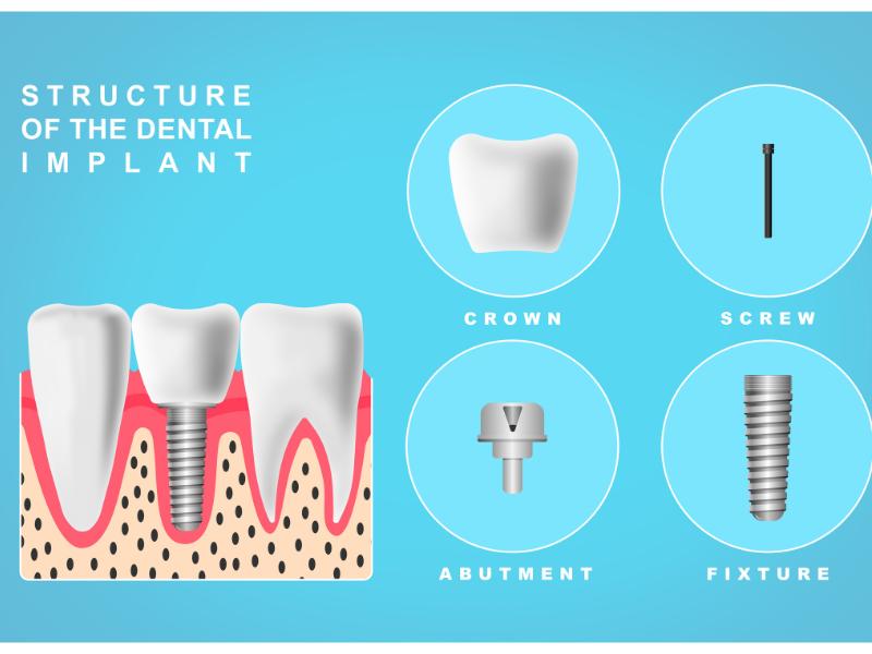 An illustration of the components that make up a dental implant